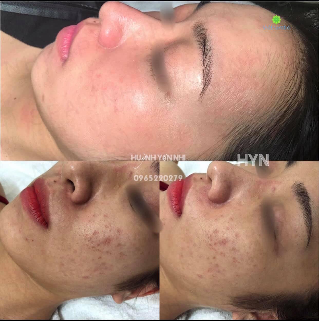 Nhi Spa Vũng Tàu - Chuyên nhận điều trị những ca da bị hư thương nặng