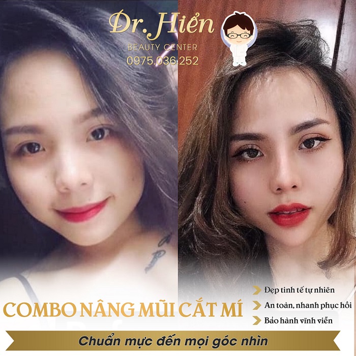 Bác sĩ Vũ Đức Hiển với kinh niệm 7 năm nâng mũi 