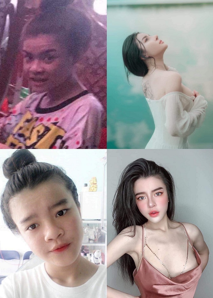 Ngoài nâng mũi còn thực hiện các ca phẫu thuật nâng ngực 