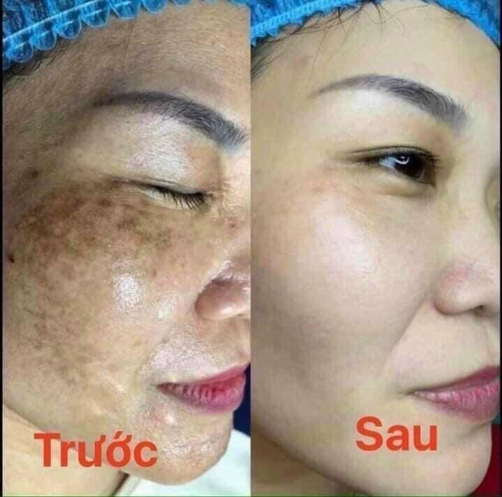 Viện thẩm mỹ My Sun tiên phong về công nghệ trị nám thế hệ mới Melasma