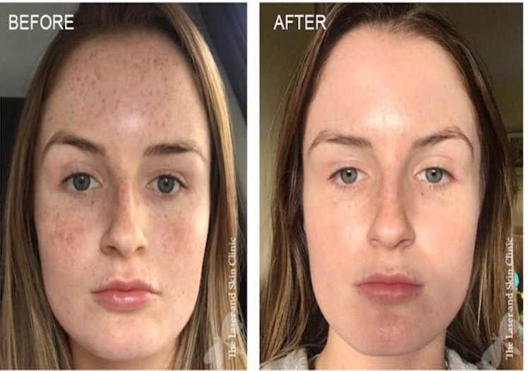 Minh họa hiệu quả peel da mang lại