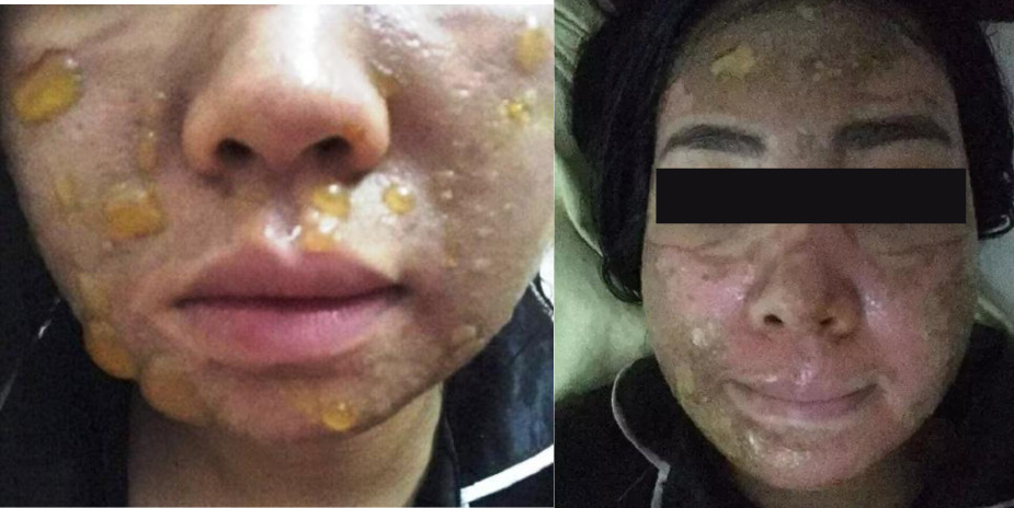 Một số biến chứng có thể gặp phải khi peel da không an toàn