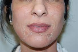 Hình minh họa quá trình peel da hóa học